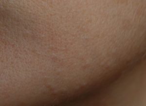 Бесцветная сыпь на лице