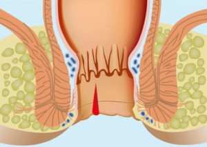Покалывание в заднем проходе