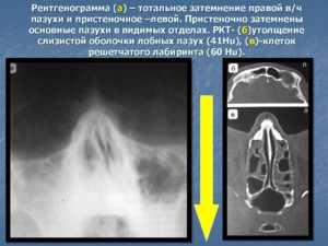 Утолщение слизистой в/ч, клеток решетчатого лабиринта