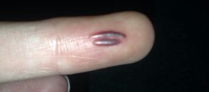 Глубокий порез руки. Отек это нормально?