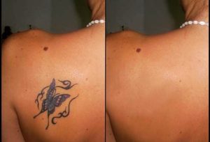Солярий после удаления татуировки?