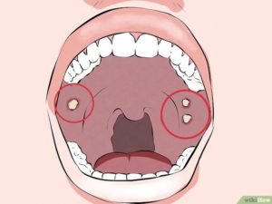 Язвочка на небе