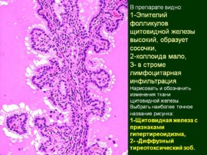 Пролиферация фолликулярного эпителия