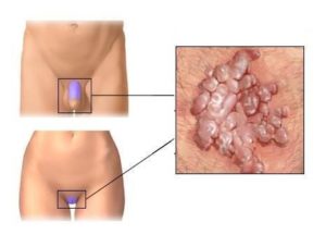 Опухает половая губа после секса