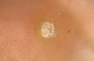 Образования типа мозолей между ягодиц