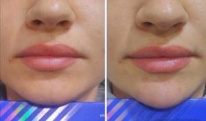 Осложнения после коррекции подбородка филлером