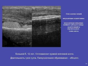 Образование в мягких тканях
