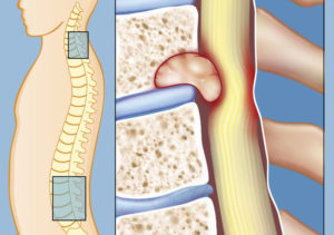 Киста и протрузии в пояснично-крестцовом отделе позвоночника