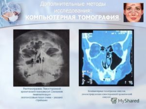 Правосторонний гемисинусит