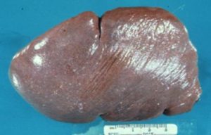 Увеличена селезенки при беременности