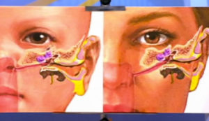 Боль в ухе после лечения гайморита