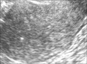 Гиперэхогенный участок шейки матки
