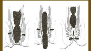 Кал не доходит до прямой кишки