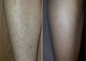 Темные пятна после ран