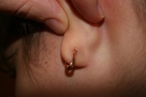 После прокола уха появилась опухоль как угорь