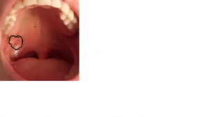 Пузырьки под миндалиной