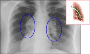 Спайки после пневмонии