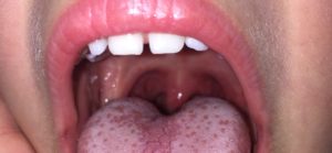 Пузырьки под миндалиной