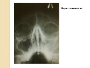 Правосторонний гемисинусит