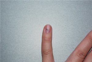 Прищемила палец дверью машины