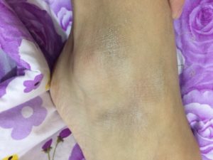 Сухая кожа на щиколотке возле косточки