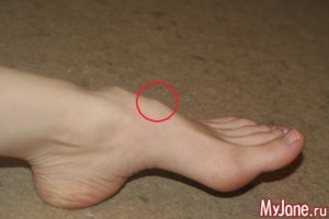 Выпирает косточка на одной стопе у ребенка