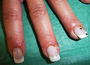 После наращивания ногтей чешутся пальцы