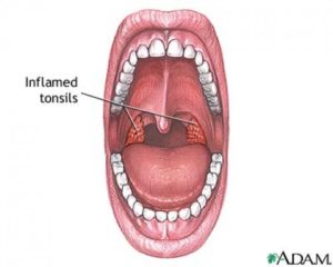 Белая полоса за гландами