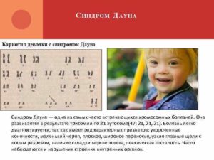 Синдром дауна по кариотипу