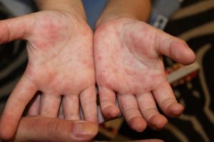 Сыпь на ладонях и ступнях