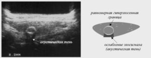 Гиперэхогенный участок шейки матки