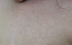 Сыпь чуть ниже груди у ребенка 12 лет