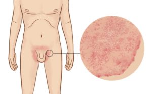 Краснота вокруг половых органов