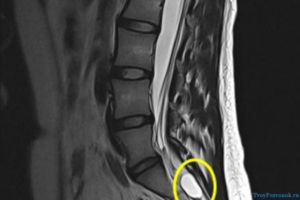 Киста и протрузии в пояснично-крестцовом отделе позвоночника