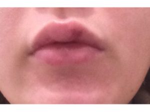 Комки после филлера