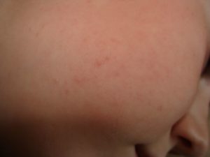 Прыщики на щеке у ребенка