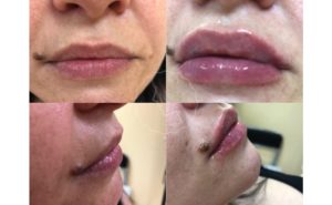 Комки после филлера