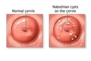 Обнаружили белое пятно на шейке матки