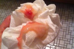 Белые выделения после постинора