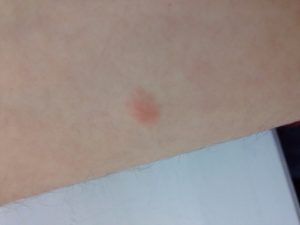 Выпуклые красные пятна на коже, твердые и чешутся