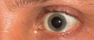 Белый шарик во внутреннем уголке глаза как жировик