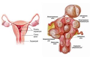 Онкомаркеры, миома матки, аденомиоз