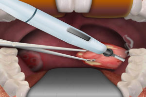 После удаления миндалин