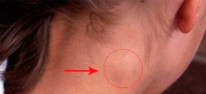 Лимфоузлы при остеохондрозе?