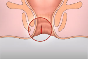 Покалывание в заднем проходе