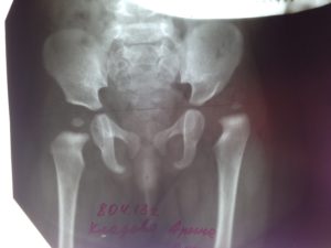 Дисплазия рентген расшифровка