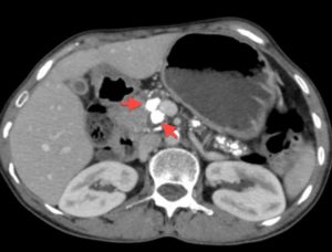 Что такое кальцинаты в поджелудочной до 3мм