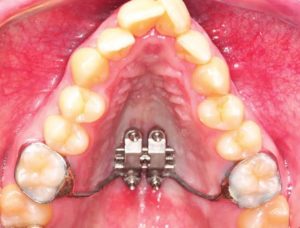 Готическое нёбо