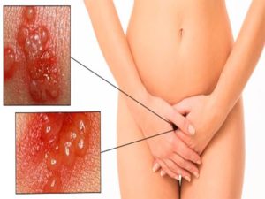 Высыпания на вульве