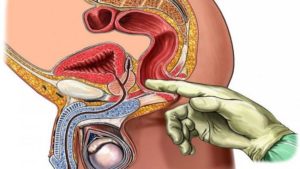 Что колят под яички при лечении простатита